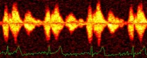Transthoracic Parametric Doppler Echosense